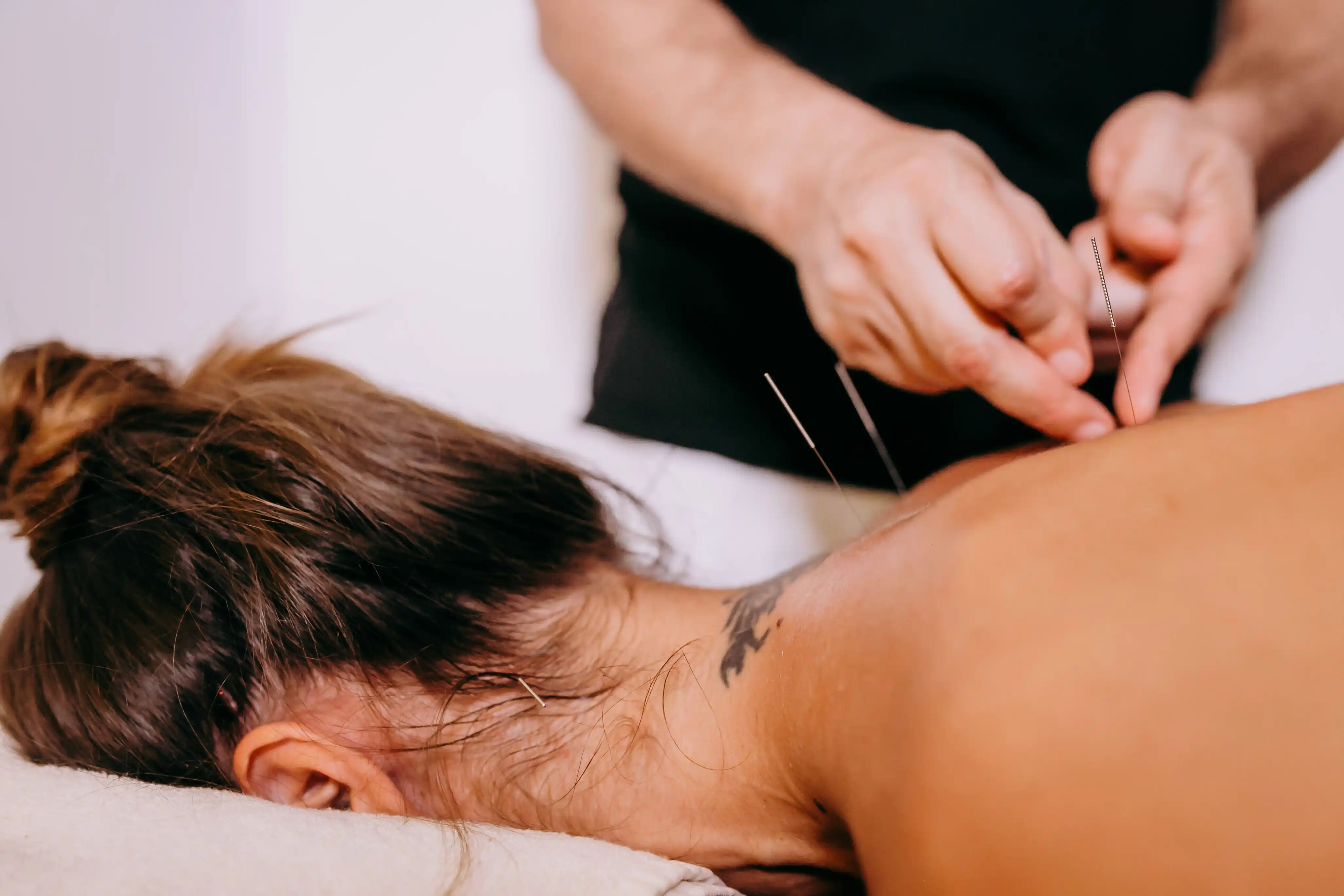 Acupuncture selon Mann