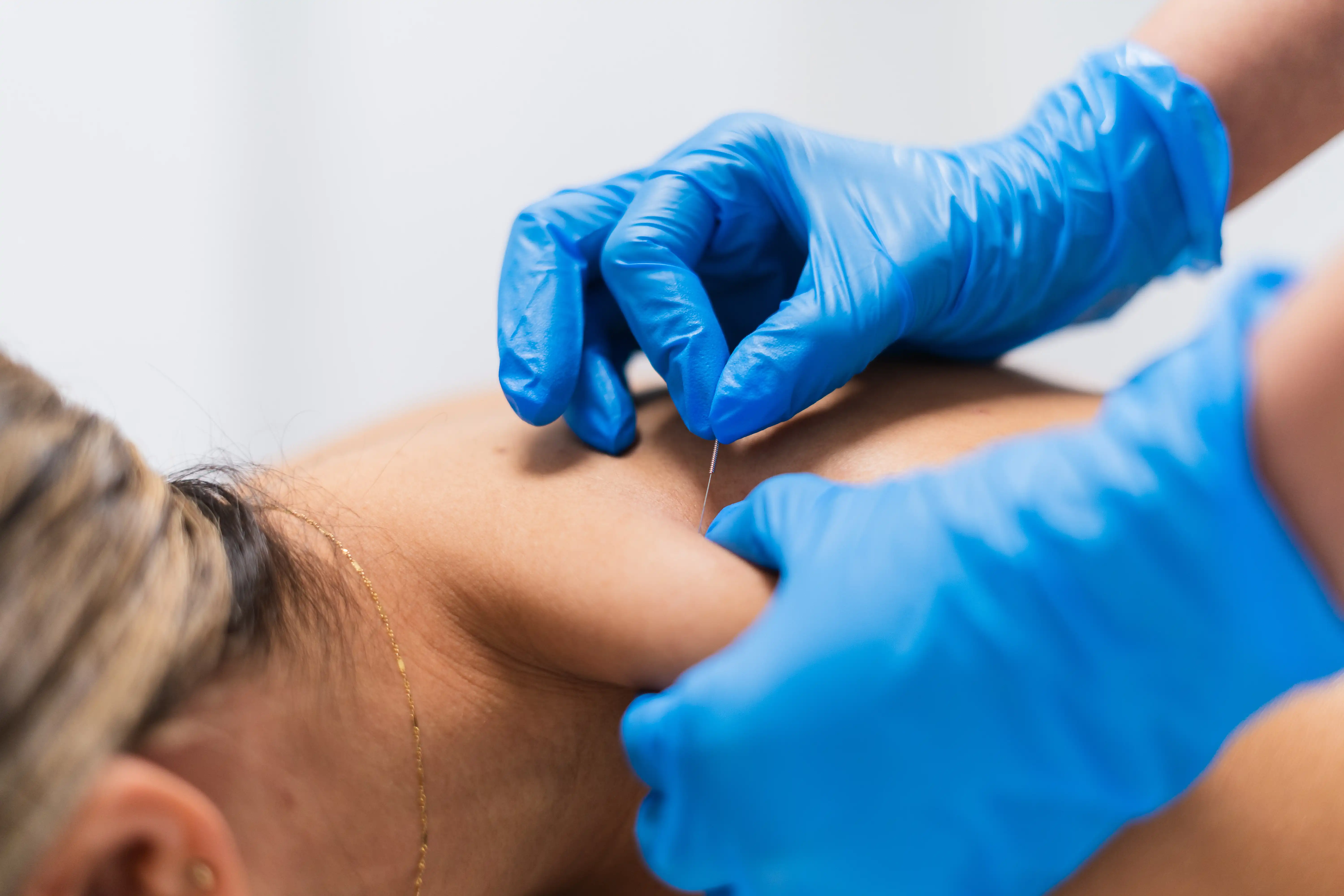 Séance de Dry Needling