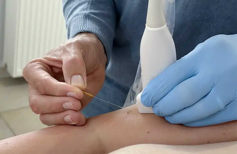 Séance de Dry Needling échoguidé